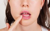[ẢNH] Những giải pháp tự nhiên giúp điều trị nhiệt miệng cực hiệu quả