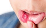 [ẢNH] Những giải pháp tự nhiên giúp điều trị nhiệt miệng cực hiệu quả