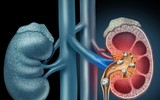 [ẢNH] Những dấu hiệu cảnh báo sớm bệnh sỏi thận bạn nên biết