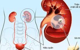 [ẢNH] Những dấu hiệu cảnh báo sớm bệnh sỏi thận bạn nên biết