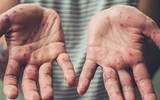 [ẢNH] 5 căn bệnh nguy hiểm thường dễ mắc vào mùa hè và cách chữa trị
