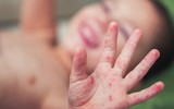 [ẢNH] 5 căn bệnh nguy hiểm thường dễ mắc vào mùa hè và cách chữa trị