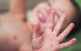 [ẢNH] 5 căn bệnh nguy hiểm thường dễ mắc vào mùa hè và cách chữa trị