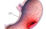 [ẢNH] Cảnh báo 10 thói quen xấu gây ung thư dạ dày