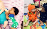 [ẢNH] Những cặp song sinh đặc biệt nhất thế giới