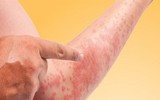 [ẢNH] Những cách đơn giản giúp phục hồi làn da cháy nắng