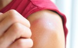 [ẢNH] Những cách đơn giản giúp phục hồi làn da cháy nắng