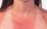 [ẢNH] Những cách đơn giản giúp phục hồi làn da cháy nắng