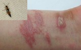 [ẢNH] Mẹo xử lý ban đầu khi bị côn trùng cắn