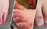 Ngón chân sưng, mất khứu giác, đỏ mắt… những dấu hiệu bất thường của Covid-19