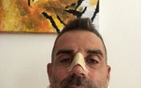 [ẢNH] Vừa đến Serie A, Ronaldo đã làm đối thủ gãy mũi và nhập viện