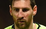 [ẢNH] Sốc với hình ảnh Messi mặt mũi bầm dập sau khi lĩnh đòn của Smalling