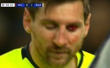[ẢNH] Sốc với hình ảnh Messi mặt mũi bầm dập sau khi lĩnh đòn của Smalling