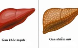 [ẢNH] Những thực phẩm bệnh nhân gan nhiễm mỡ 'nhất định phải ăn'