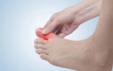 [ẢNH] Những thực phẩm 'nhất định phải ăn' khi mắc bệnh gout