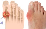 [ẢNH] Những thực phẩm 'nhất định phải ăn' khi mắc bệnh gout