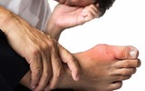 [ẢNH] Những thực phẩm 'nhất định phải ăn' khi mắc bệnh gout