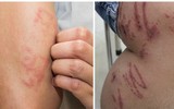[Ảnh] Nhận diện những dấu hiệu tổn thương do kiến ba khoang và cách xử lý 