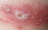 [Ảnh] Nhận diện những dấu hiệu tổn thương do kiến ba khoang và cách xử lý 