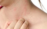 [Ảnh] Nhận diện những dấu hiệu tổn thương do kiến ba khoang và cách xử lý 