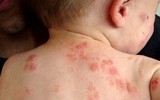 [Ảnh] Nhận diện những dấu hiệu tổn thương do kiến ba khoang và cách xử lý 
