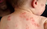 [Ảnh] Nhận diện những dấu hiệu tổn thương do kiến ba khoang và cách xử lý 