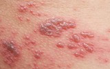 [Ảnh] Nhận diện những dấu hiệu tổn thương do kiến ba khoang và cách xử lý 