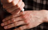 [Ảnh] Nhận diện những dấu hiệu tổn thương do kiến ba khoang và cách xử lý 