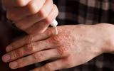 [Ảnh] Nhận diện những dấu hiệu tổn thương do kiến ba khoang và cách xử lý 