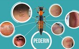 [Ảnh] Nhận diện những dấu hiệu tổn thương do kiến ba khoang và cách xử lý 