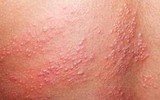 [Ảnh] Nhận diện những dấu hiệu tổn thương do kiến ba khoang và cách xử lý 