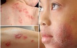 [Ảnh] Nhận diện những dấu hiệu tổn thương do kiến ba khoang và cách xử lý 