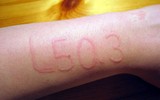 [ẢNH] Kỳ lạ chứng da vẽ nổi xuất hiện trên cơ thể con người 