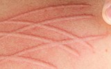 [ẢNH] Kỳ lạ chứng da vẽ nổi xuất hiện trên cơ thể con người 
