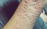[ẢNH] Kỳ lạ chứng da vẽ nổi xuất hiện trên cơ thể con người 