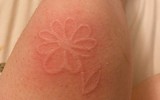 [ẢNH] Kỳ lạ chứng da vẽ nổi xuất hiện trên cơ thể con người 