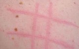 [ẢNH] Kỳ lạ chứng da vẽ nổi xuất hiện trên cơ thể con người 