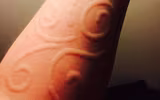 [ẢNH] Kỳ lạ chứng da vẽ nổi xuất hiện trên cơ thể con người 