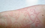 [ẢNH] Kỳ lạ chứng da vẽ nổi xuất hiện trên cơ thể con người 