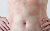 [ẢNH] Kỳ lạ chứng da vẽ nổi xuất hiện trên cơ thể con người 