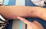 [ẢNH] Dấu hiệu và cách phòng tránh bệnh vi khuẩn 'ăn thịt người' Whitmore sau mùa mưa lũ