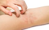 [ẢNH] Dấu hiệu và cách phòng tránh bệnh vi khuẩn 'ăn thịt người' Whitmore sau mùa mưa lũ