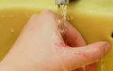 [ẢNH] Dấu hiệu và cách phòng tránh bệnh vi khuẩn 'ăn thịt người' Whitmore sau mùa mưa lũ