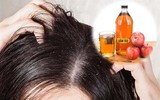 [ẢNH] 10 cách trị gàu đơn giản hiệu quả 
