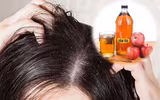 [ẢNH] 10 cách trị gàu đơn giản hiệu quả 