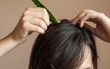 [ẢNH] 10 cách trị gàu đơn giản hiệu quả 