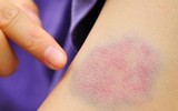 [ẢNH] Những dấu hiệu cảnh báo ung thư sớm, chớ xem thường!