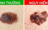 [ẢNH] Những dấu hiệu cảnh báo ung thư sớm, chớ xem thường!