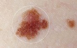[ẢNH] Những dấu hiệu cảnh báo ung thư sớm, chớ xem thường!