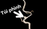 [ẢNH] Đột quỵ gia tăng ở người trẻ: Những dấu hiệu bất thường không nên bỏ qua